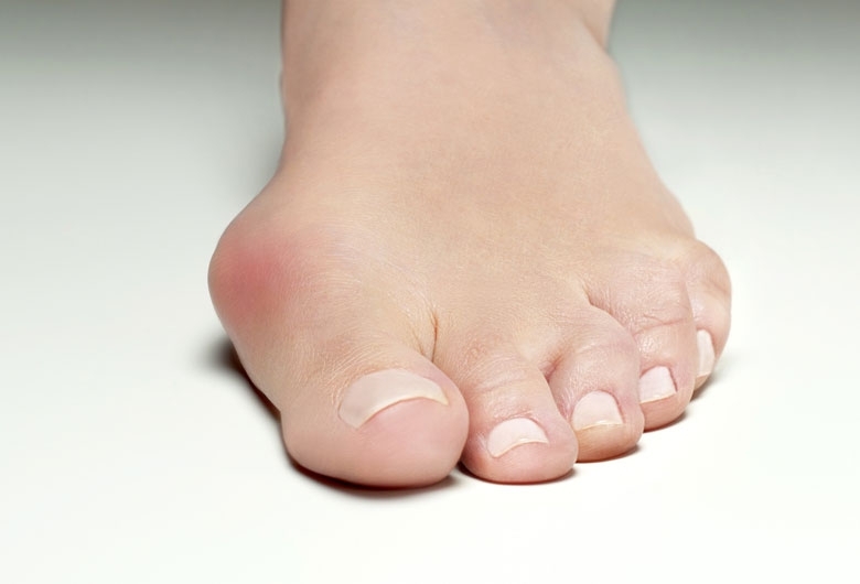 Cos’è l’alluce valgo? Cos’è l’alluce valgo?