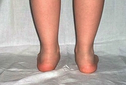 La patologia del piede valgo 