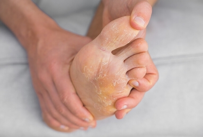 Funghi ai piedi: come riconoscerli e curarli