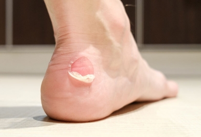 Bolle ai piedi: cause e rimedi delle vesciche 