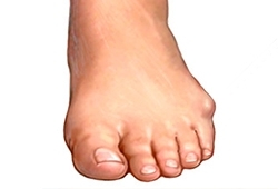 Deformità del piede: è il 5° dito varo