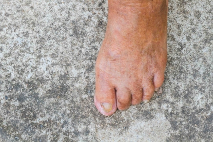 Unghie dei piedi gialle quali le cause?