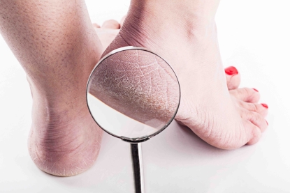 La secchezza dei piedi: cause e prevenzione