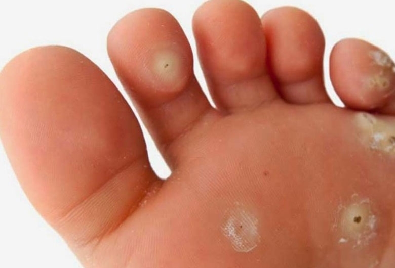 Occhio di pernice: cos'è e come prevenirlo? Occhio di pernice: cos'è e come prevenirlo?