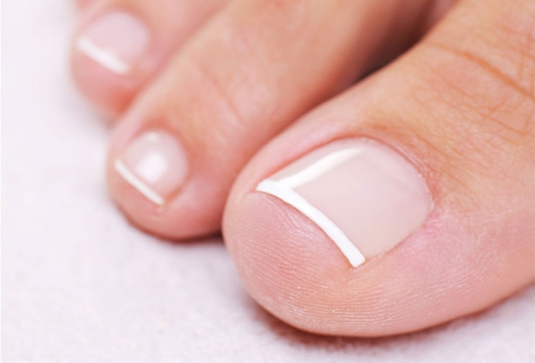 Unghie rigate: perché? Unghie rigate: perché?