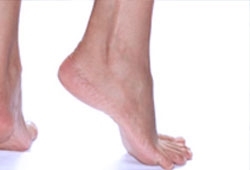 Il piede equino Il piede equino