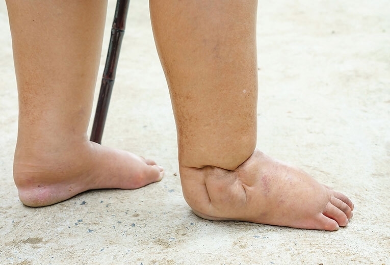 Il piede diabetico: cosa fare e cosa non fare