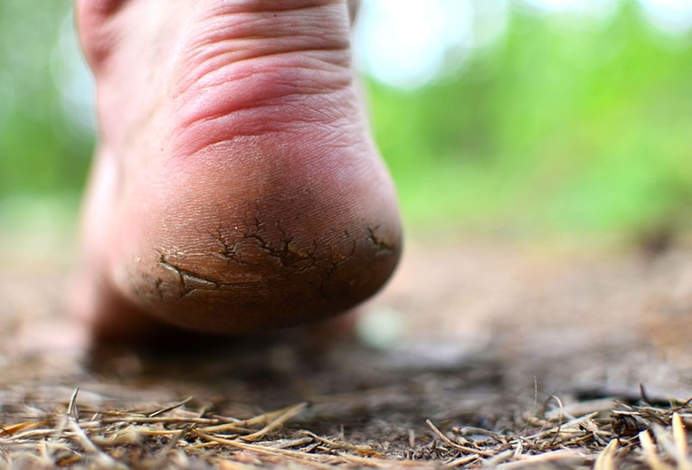 Le ragadi ai piedi e i talloni screpolati Le ragadi ai piedi e i talloni screpolati