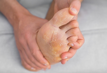Onicomicosi: Micosi alle unghie dei piedi