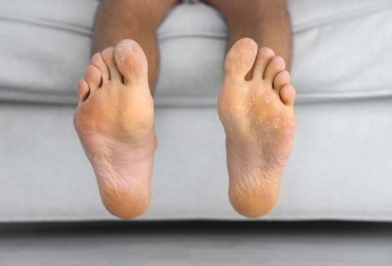 Piede d'atleta: di cosa si tratta? Piede d'atleta: di cosa si tratta?