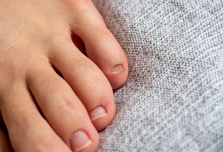 Segni sulle unghie: cosa significano?