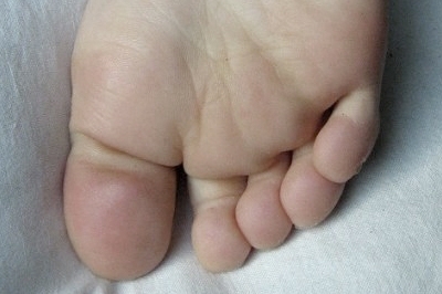Piedi freddi e blu: è la sindrome di Raynaud  Piedi freddi e blu: è la sindrome di Raynaud