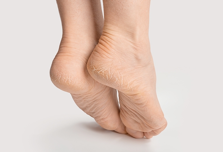 Disidrosi ai piedi: cos'è e come trattarla? Disidrosi ai piedi: cos'è e come trattarla?