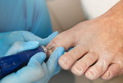 Malattie delle unghie: cause e prevenzione