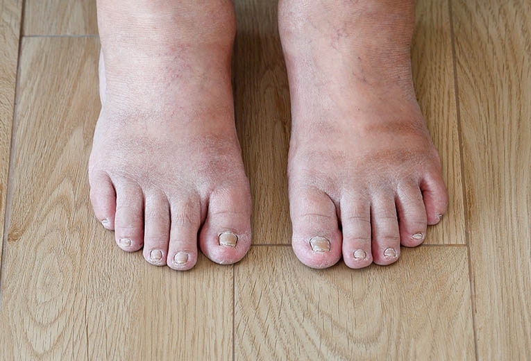 Piedi gonfi: quando preoccuparsi Piedi gonfi: quando preoccuparsi