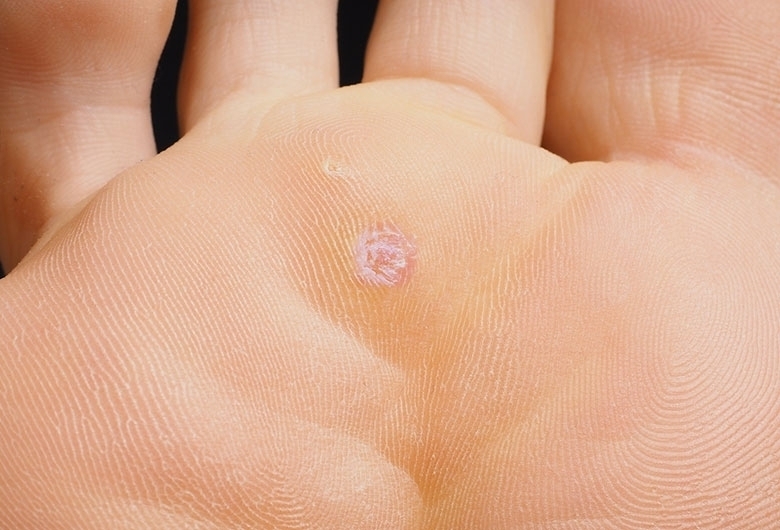 Eliminare Verruche Mani E Piedi Con Laserterapia - Centro Genesy Vicenza - Foto 9