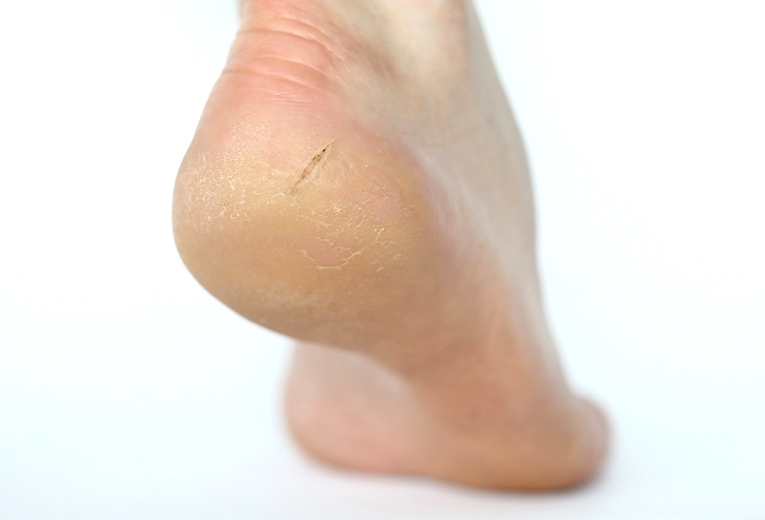 Ragadi ai piedi: cause e cura Ragadi ai piedi: cause e cura