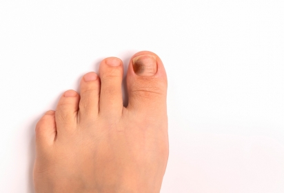 Unghia nera del piede: cause e rimedi