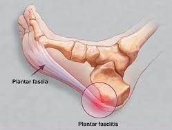 Botox e fascite plantare Botox e fascite plantare