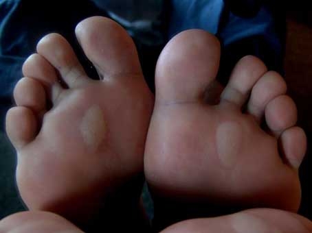 Vesciche sui piedi: piccolo problema, grande fastidio Vesciche sui piedi: piccolo problema, grande fastidio